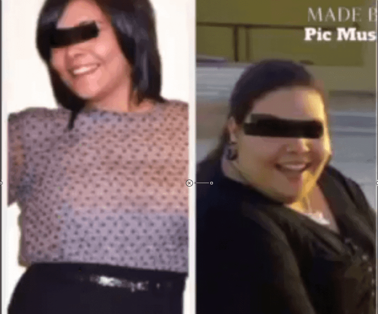 Gastric Sleeve