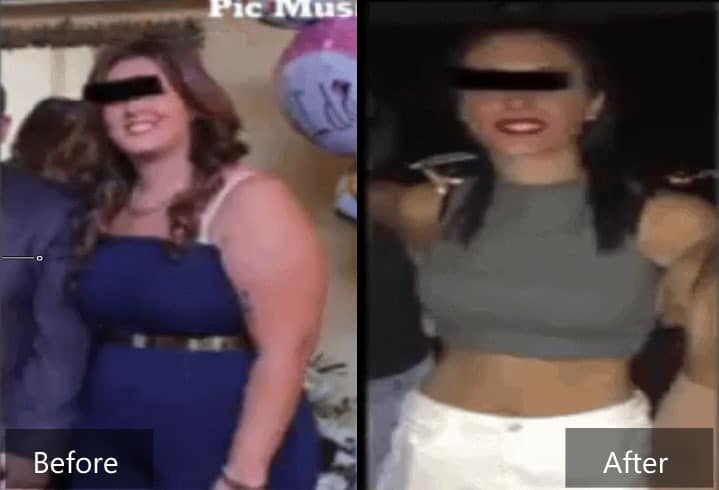 Weight loss surgery before and after