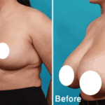 breast-reduction