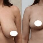 Chirurgie de réduction mammaire
