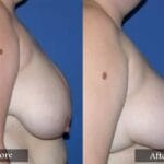 Breast Reduction before and after