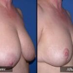 Breast Reduction before and after