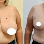 Breast Reduction before and after