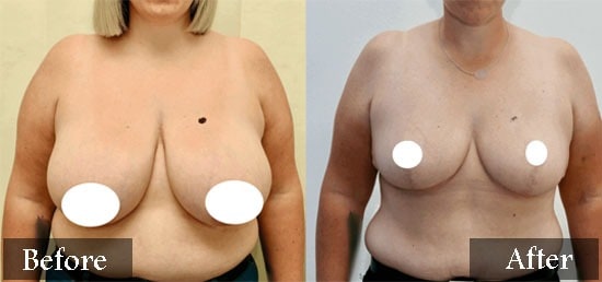 Breast Reduction before and after