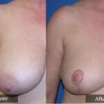 Breast Reduction before and after