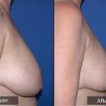 Breast Reduction before and after
