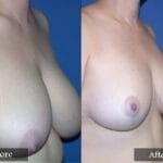 Breast Reduction before and after