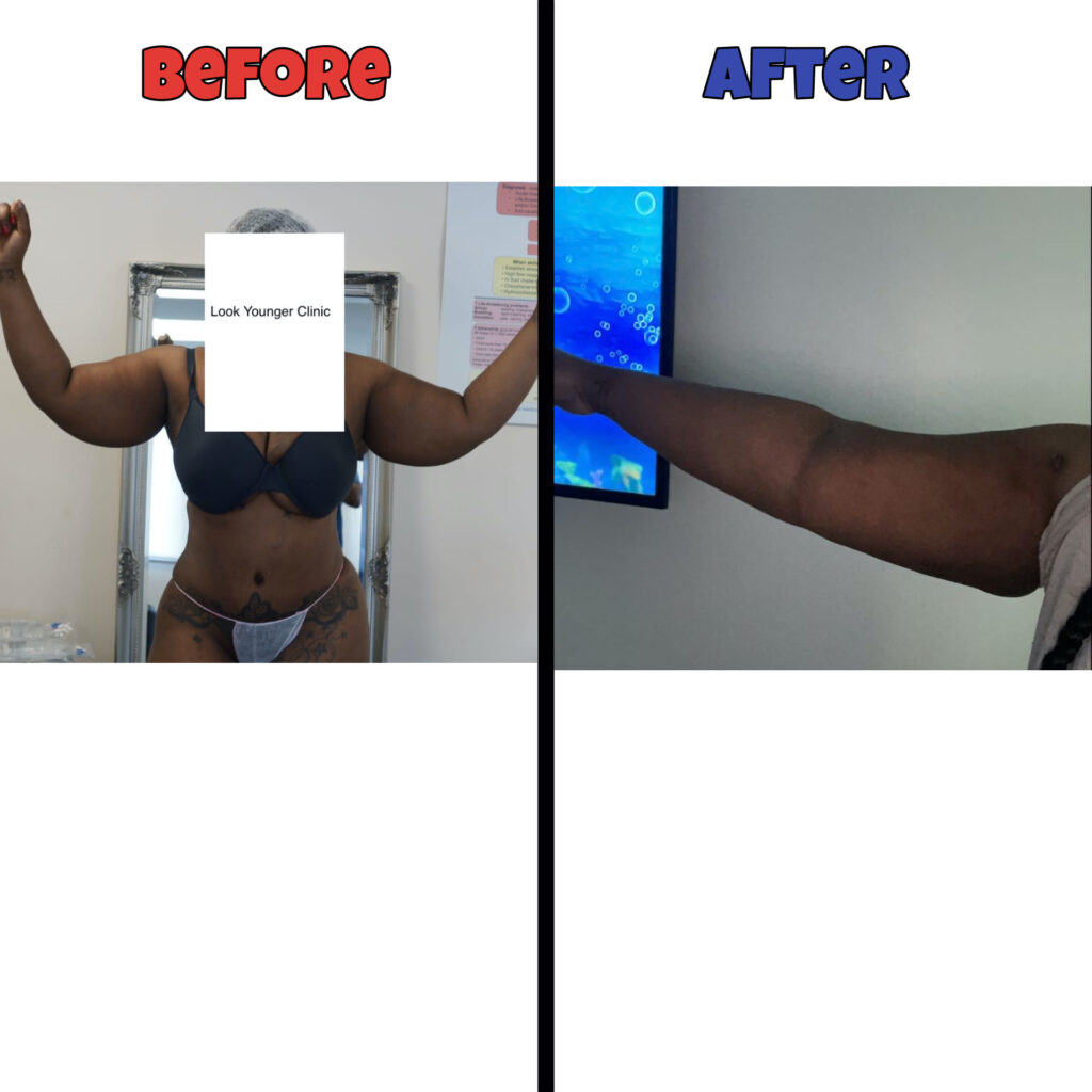 Lipo arms before and after