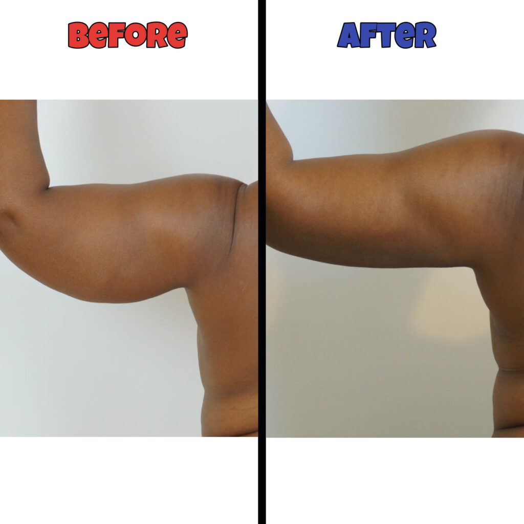 lipo arms before and after