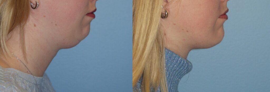Chin Lipo before and after