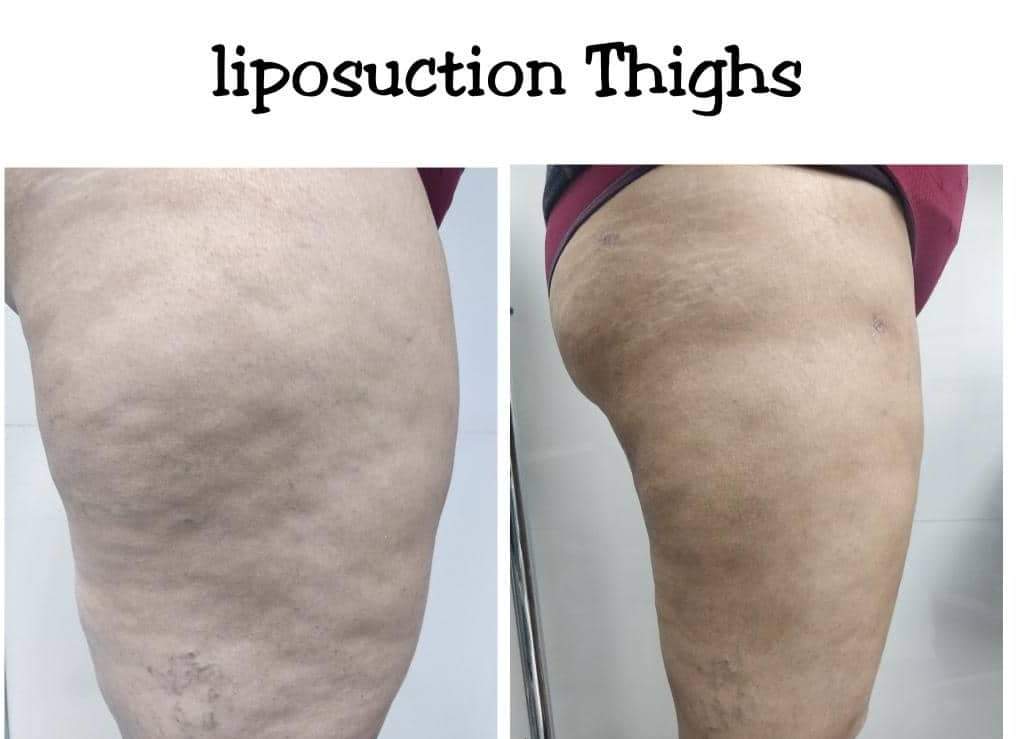 Lipo Thighs before and after photo