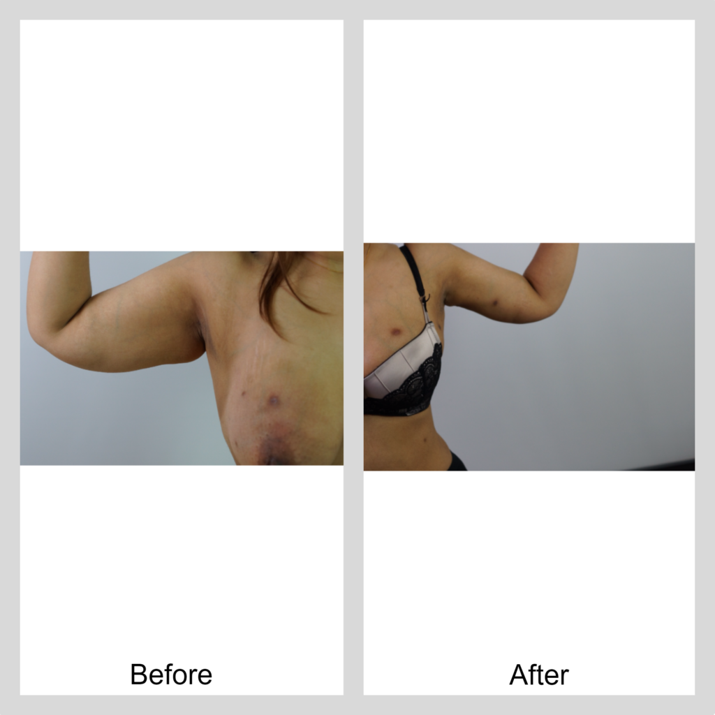lipo arms before and after