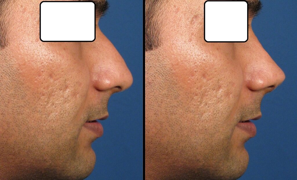 Indian nose rhinoplasty