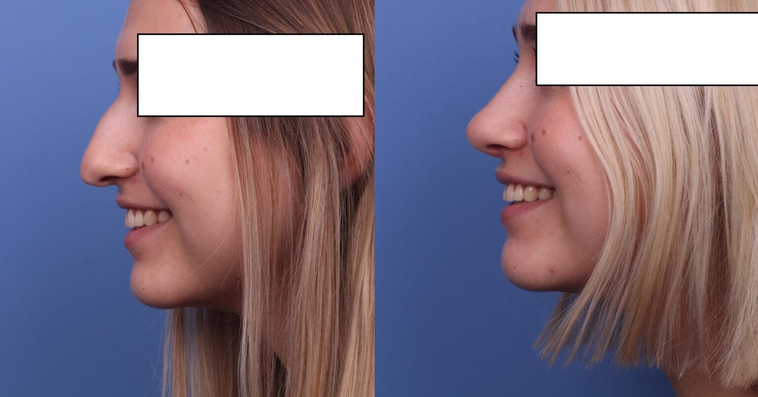 Rhinoplasty (Nose Job) Cost £1500, London UK Look Younger Clinic