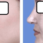 Rhinoplasty before and after