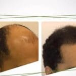 Hair Transplant UK
