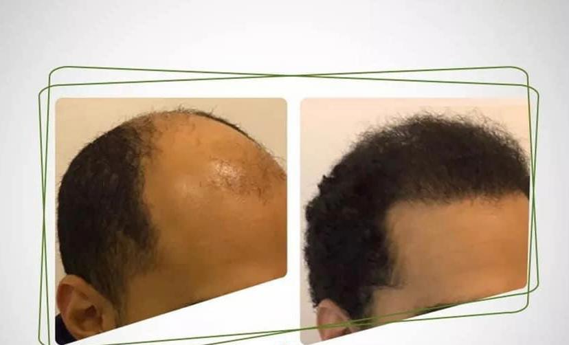 Hair-Transplant-Before-After