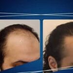 Hair Transplant UK