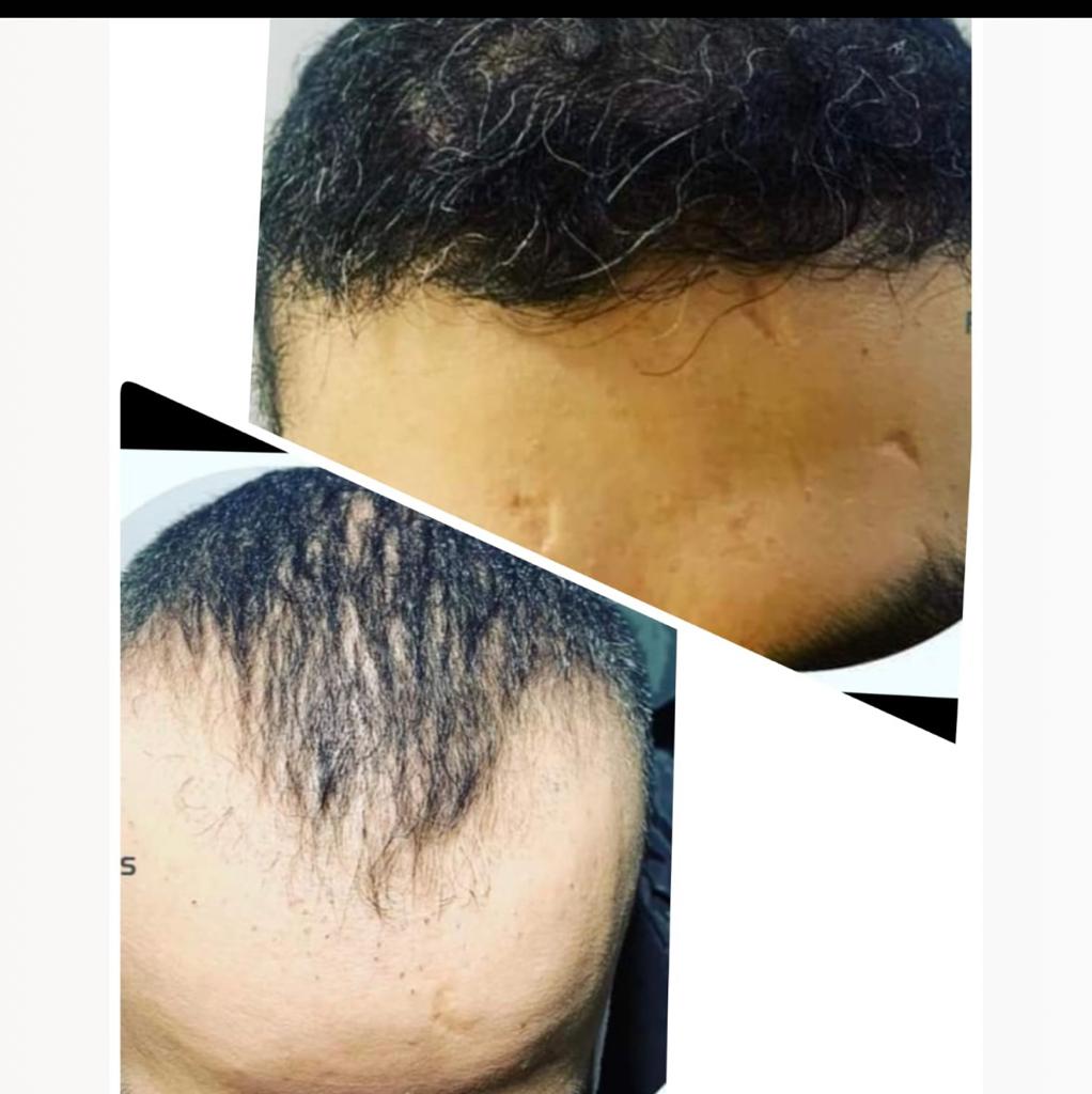 Hair-transplant-Before-After