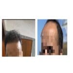 Hair-transplant-before-after