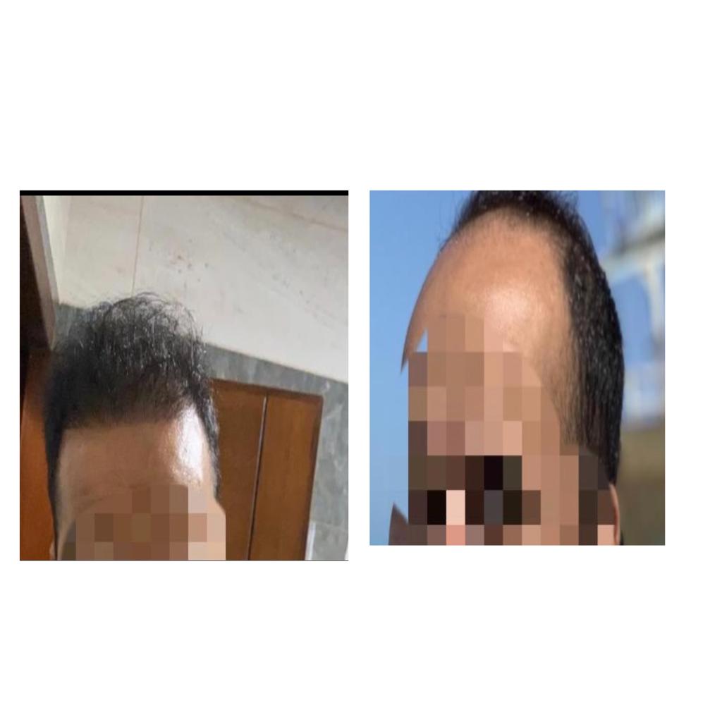Hair-transplant-before-after