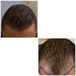 Hair Transplant UK
