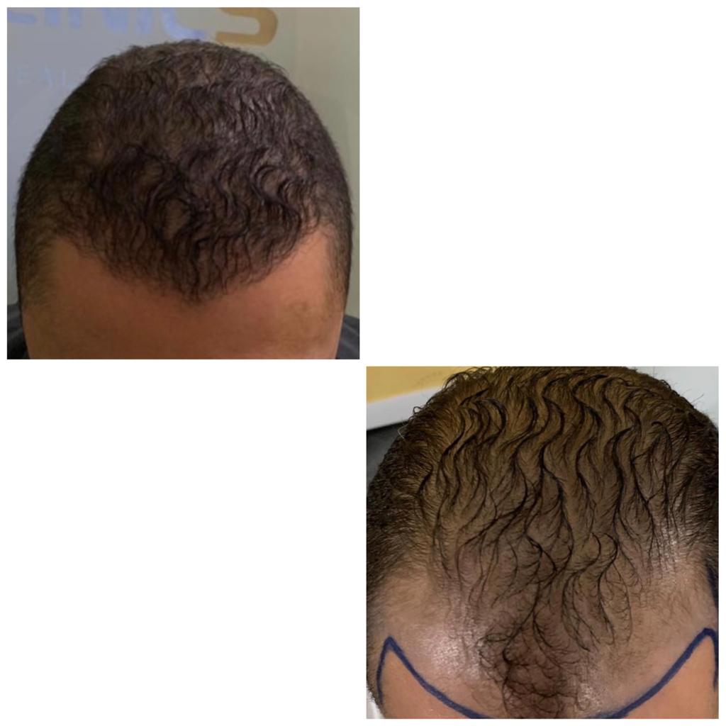 Hair-Transplant-Before-After