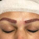Hair Transplant UK