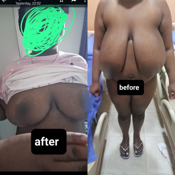 Breast Reduction Surgery