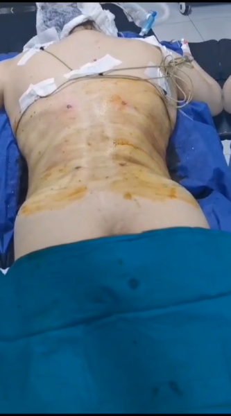 Post Op Tummy