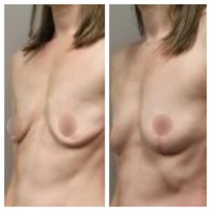 breast fat transfer1
