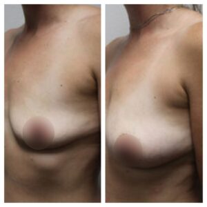 breast fat transfer10