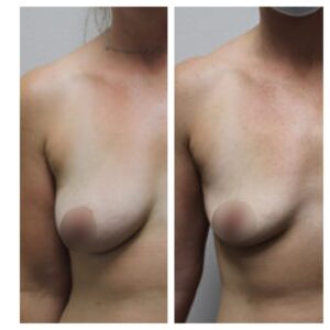 breast fat transfer13