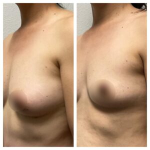 breast fat transfer14
