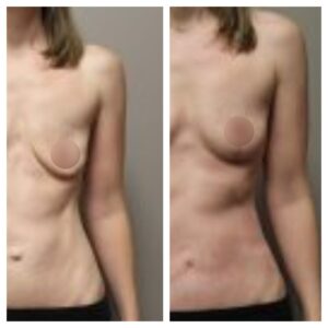 breast fat transfer2