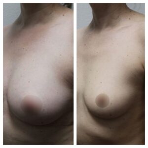 breast fat transfer4