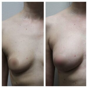 breast fat transfer5