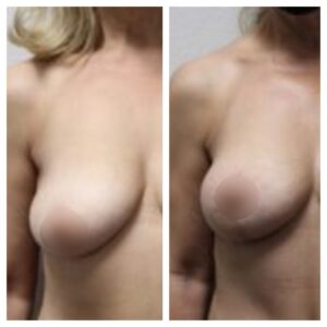 breast fat transfer7