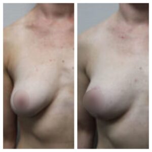 breast fat transfer9