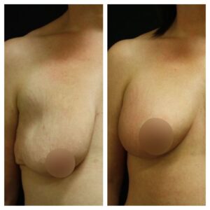 breast uplift