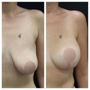 breast uplift