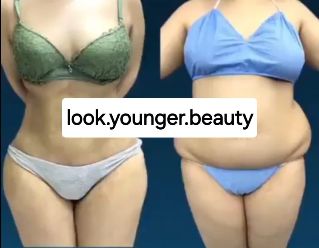 Tummy Tuck Before and After