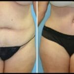 Liposuction tummy before and after