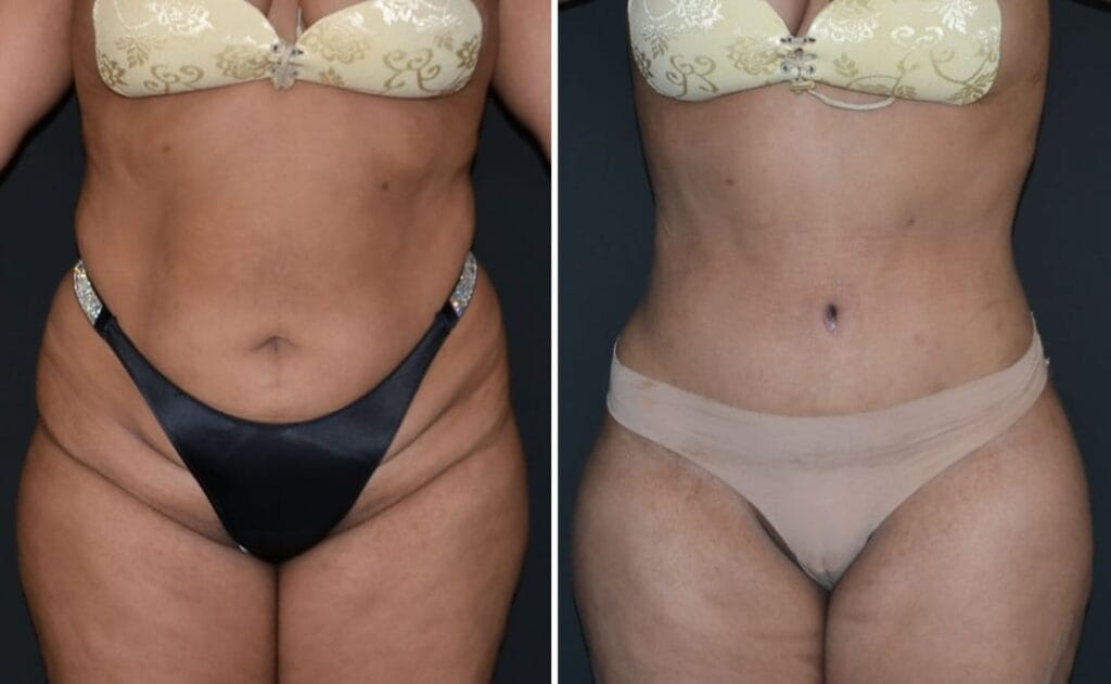 Tummy Tuck before and after