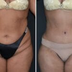 Tummy Tuck before and after