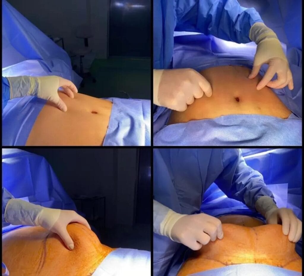 Tummy Tuck before and after