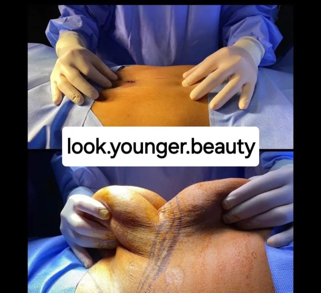 Tummy Tuck before and after