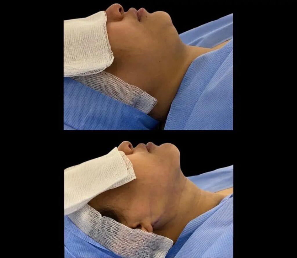 Chin liposuction before and after