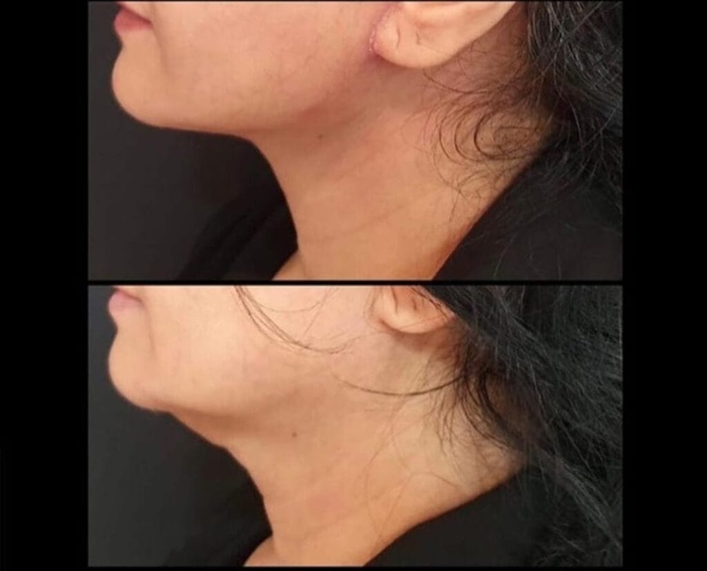 Chin Lipo before and after