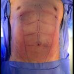 Liposuction tummy male before and after